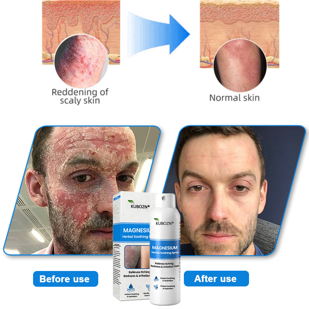 ✅ Official Store: Kubozn® Magnesium Herbal Skin Relief Spray Helps calm irritated, itchy & problem-prone skin