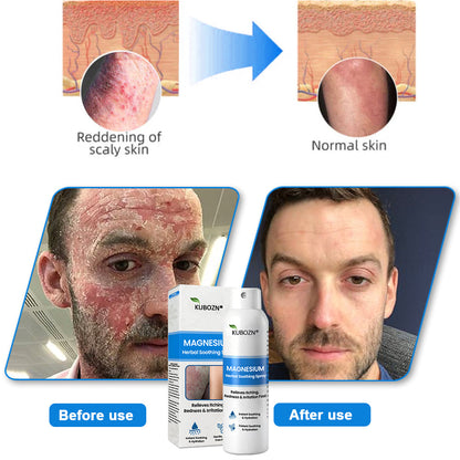 ✅ Official Store: Kubozn® Magnesium Herbal Skin Relief Spray Helps calm irritated, itchy & problem-prone skin